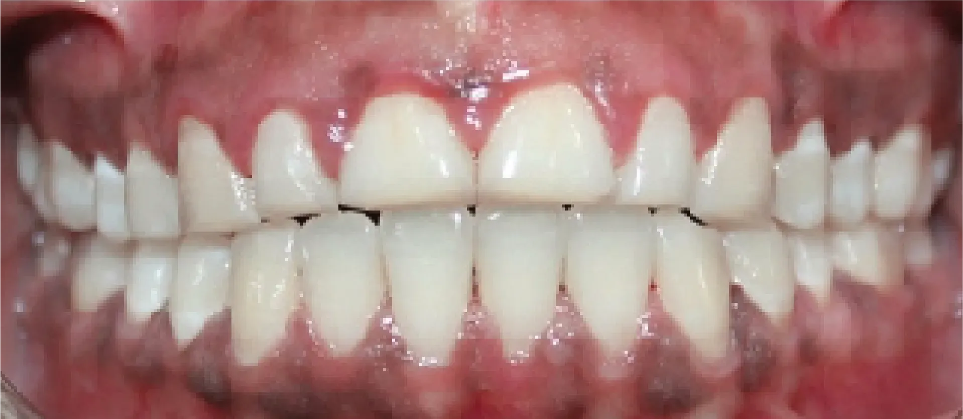 After Teeth Alignment at DentoCorrect