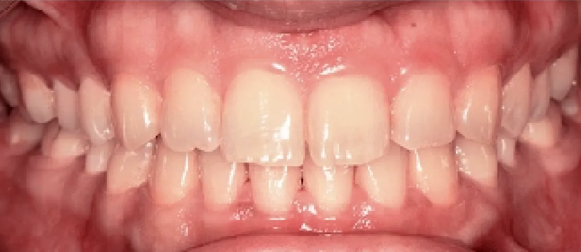 After Orthodontic Treatment at DentoCorrect