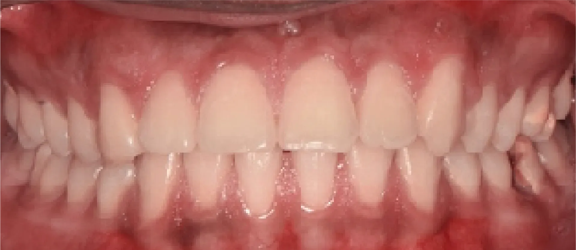 After Dental Transformation at DentoCorrect