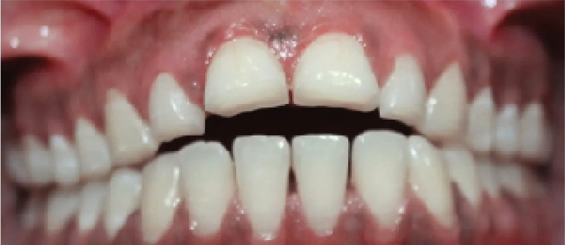 Before Teeth Alignment at DentoCorrect