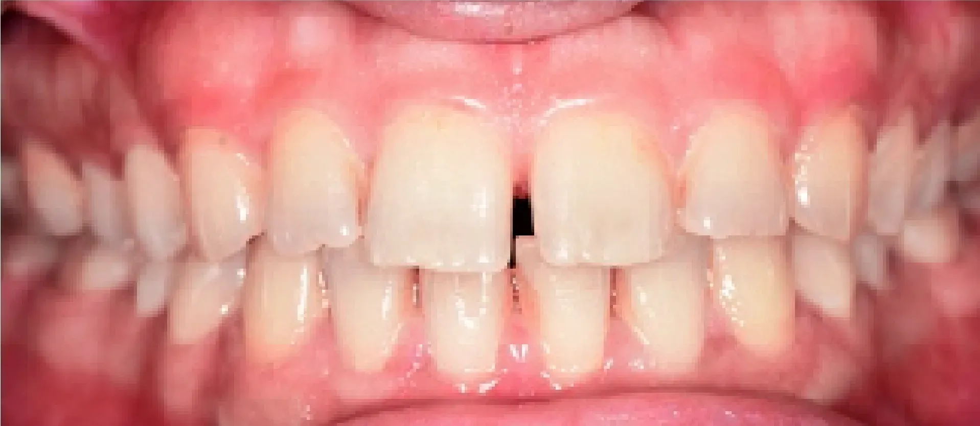 Before Orthodontic Treatment at DentoCorrect
