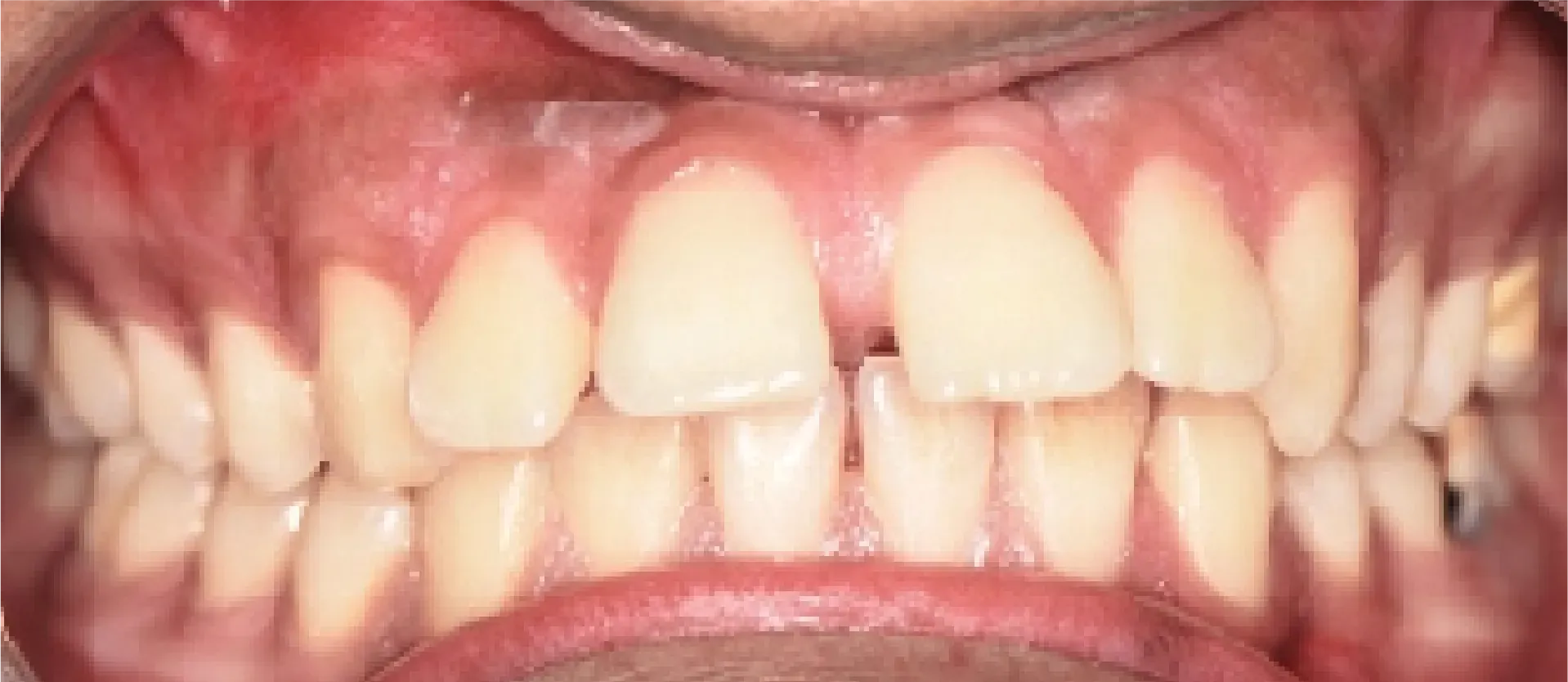 Before Dental Transformation at DentoCorrect