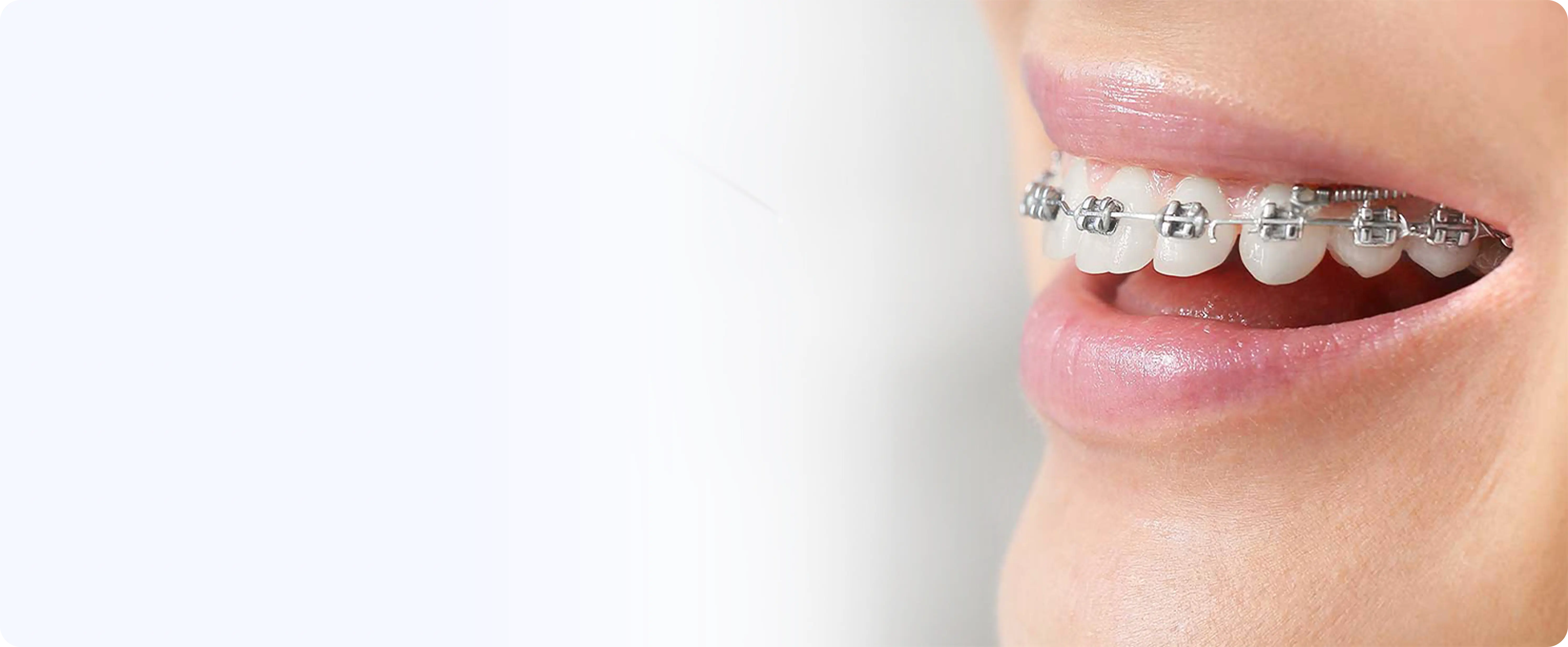 Dental braces treatment at DentoCorrect