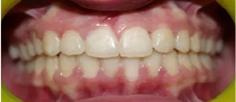 After Clear Aligner Treatment at DentoCorrect