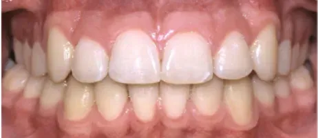 After Dental Braces Treatment at DentoCorrect
