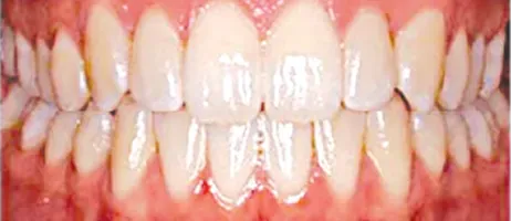 After Smile Correction at DentoCorrect