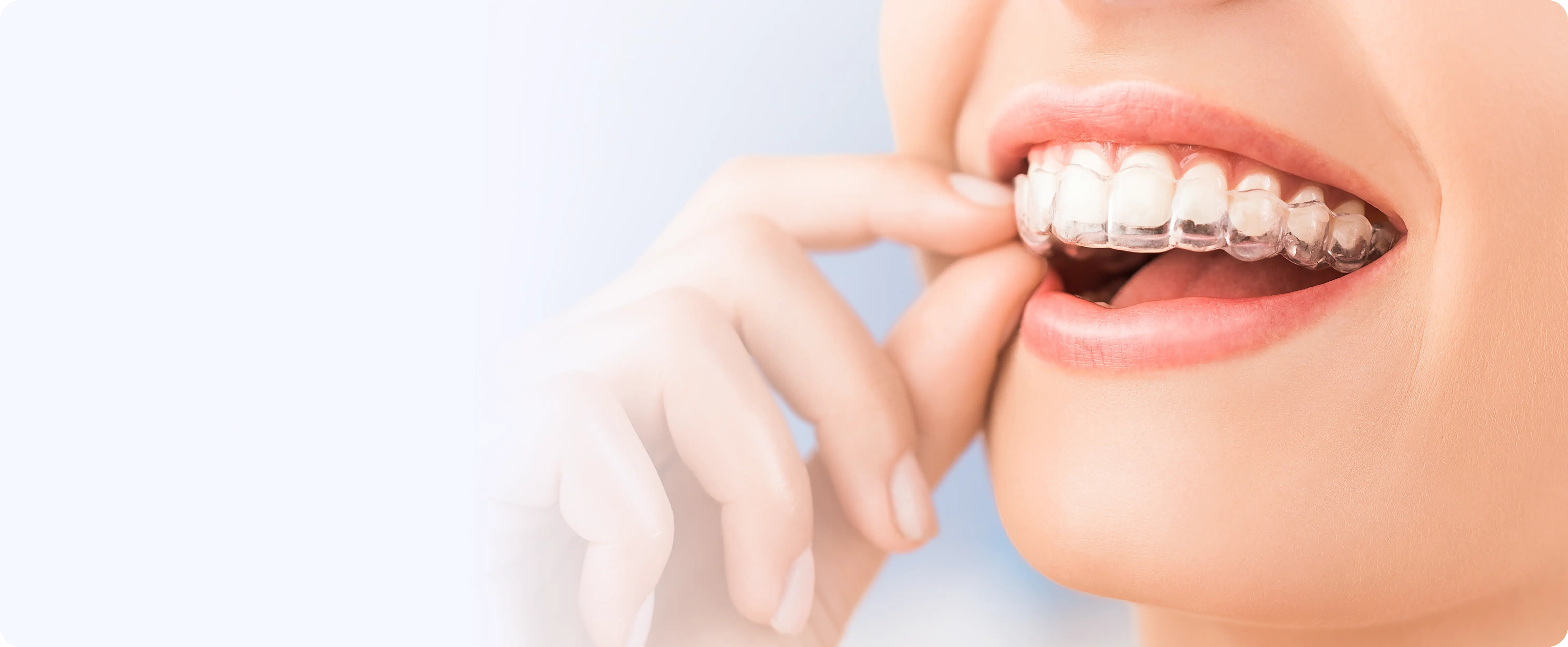 Clear aligner treatment at DentoCorrect