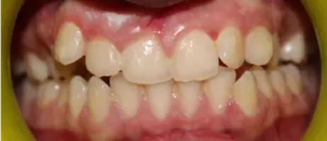 Before Clear Aligner Treatment at DentoCorrect