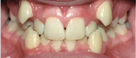 Before Dental Braces Treatment at DentoCorrect