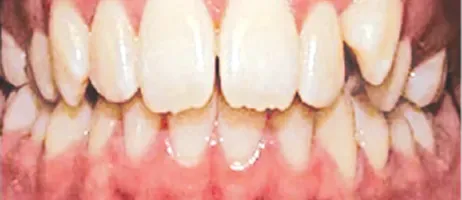 Before Smile Correction at DentoCorrect