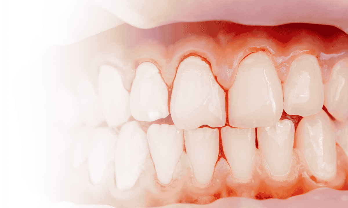 Bleeding Gums Causes And Treatment
