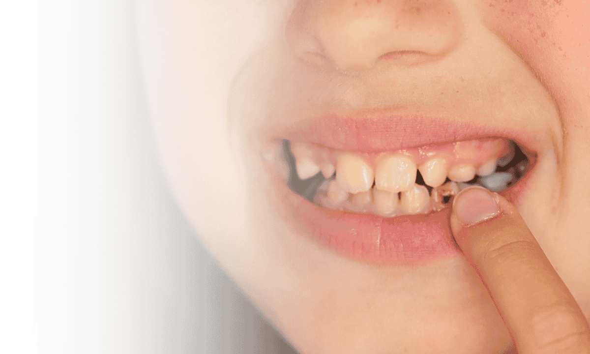 Different Types of Bite Problems and Their Treatments