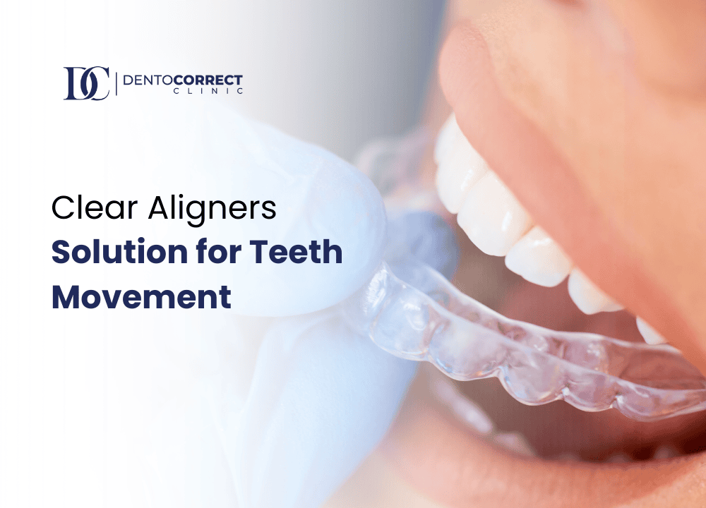 Clear Aligners Solution for Teeth Movement