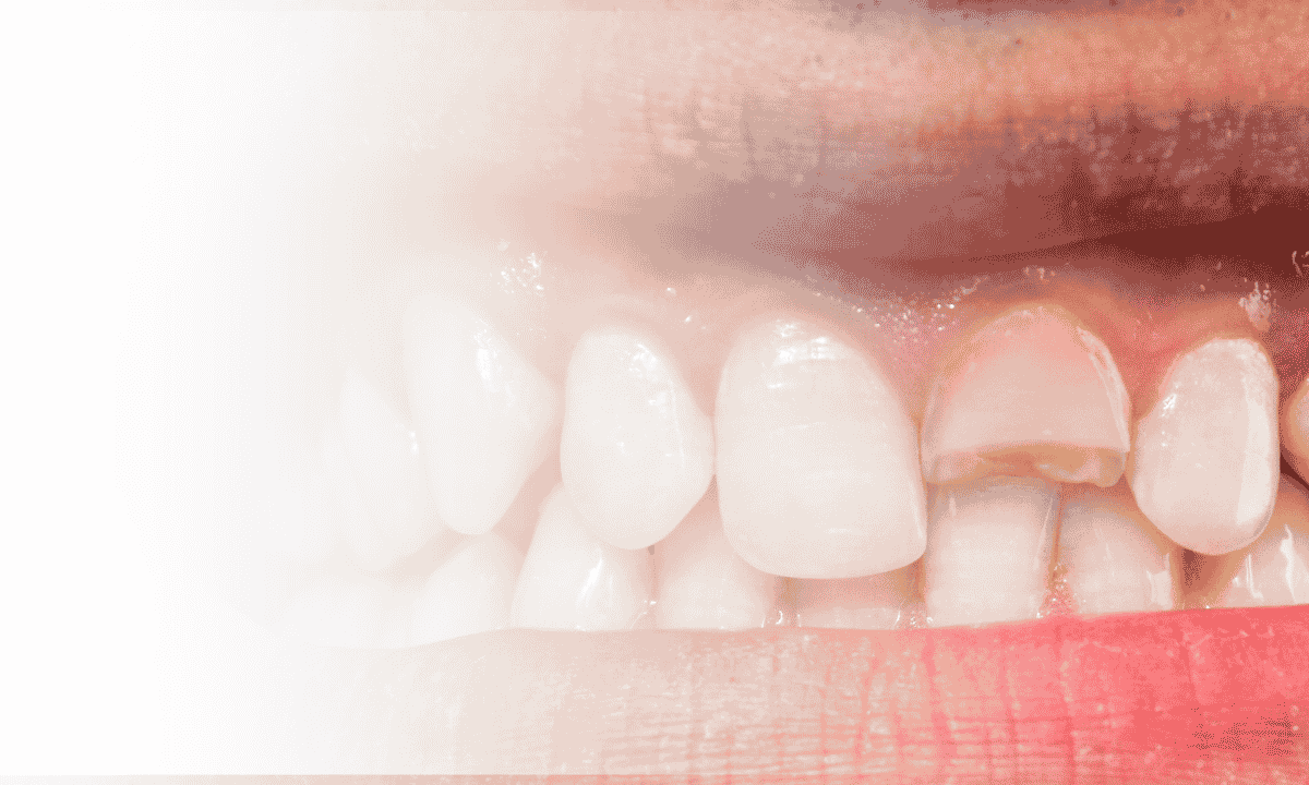 How to Fix a Cracked Tooth