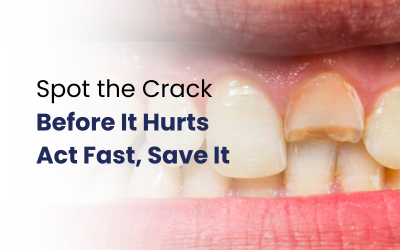 How to Fix a Cracked Tooth