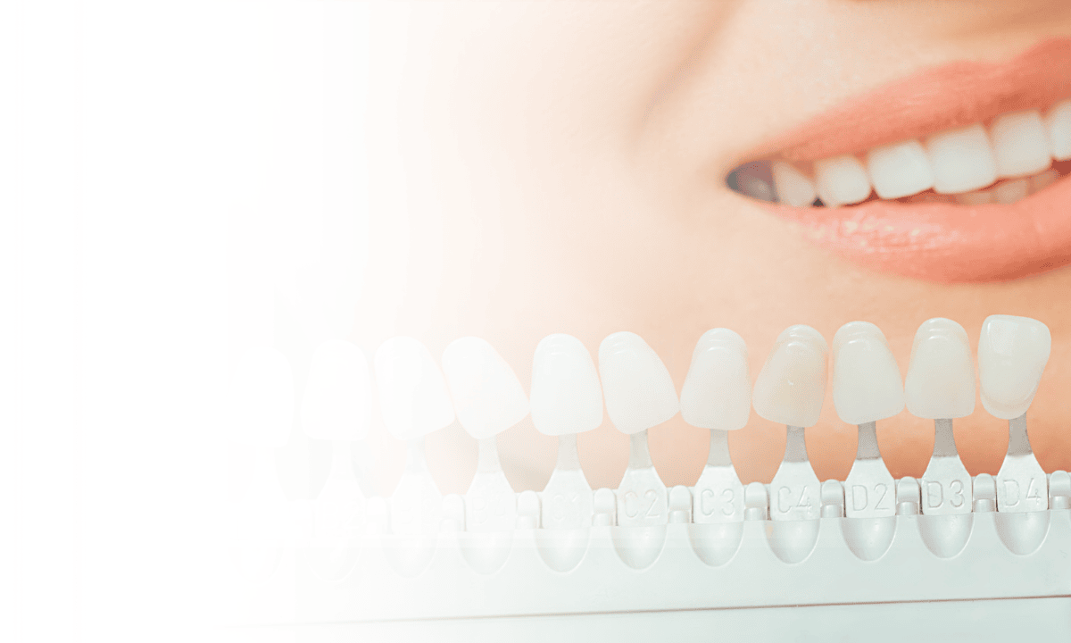 In-Clinic vs At-Home Teeth Whitening