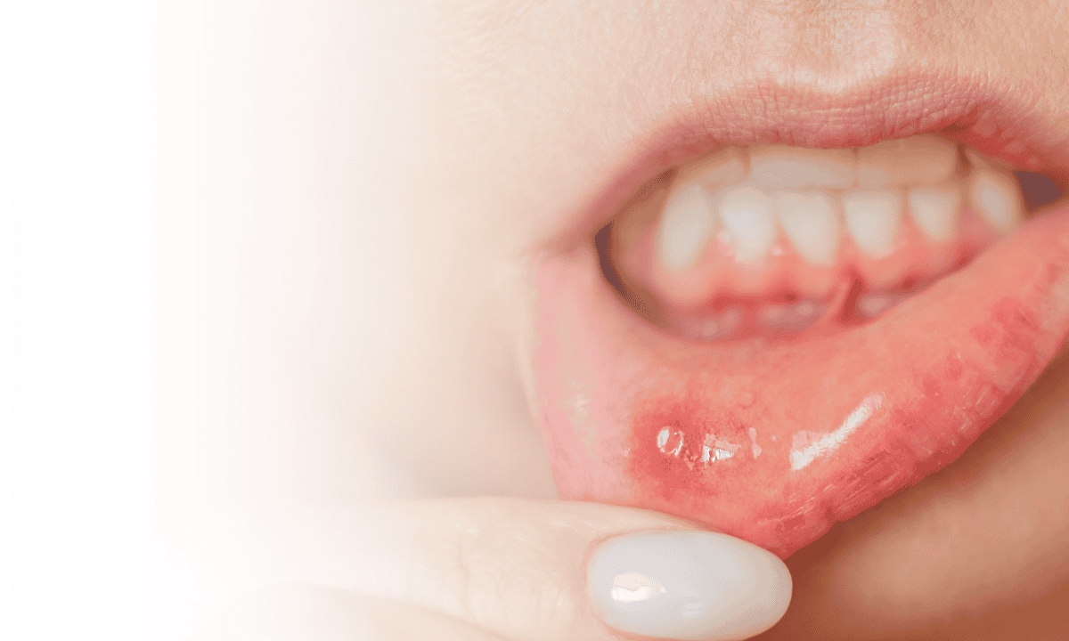 Top Mouth Ulcer Treatment's