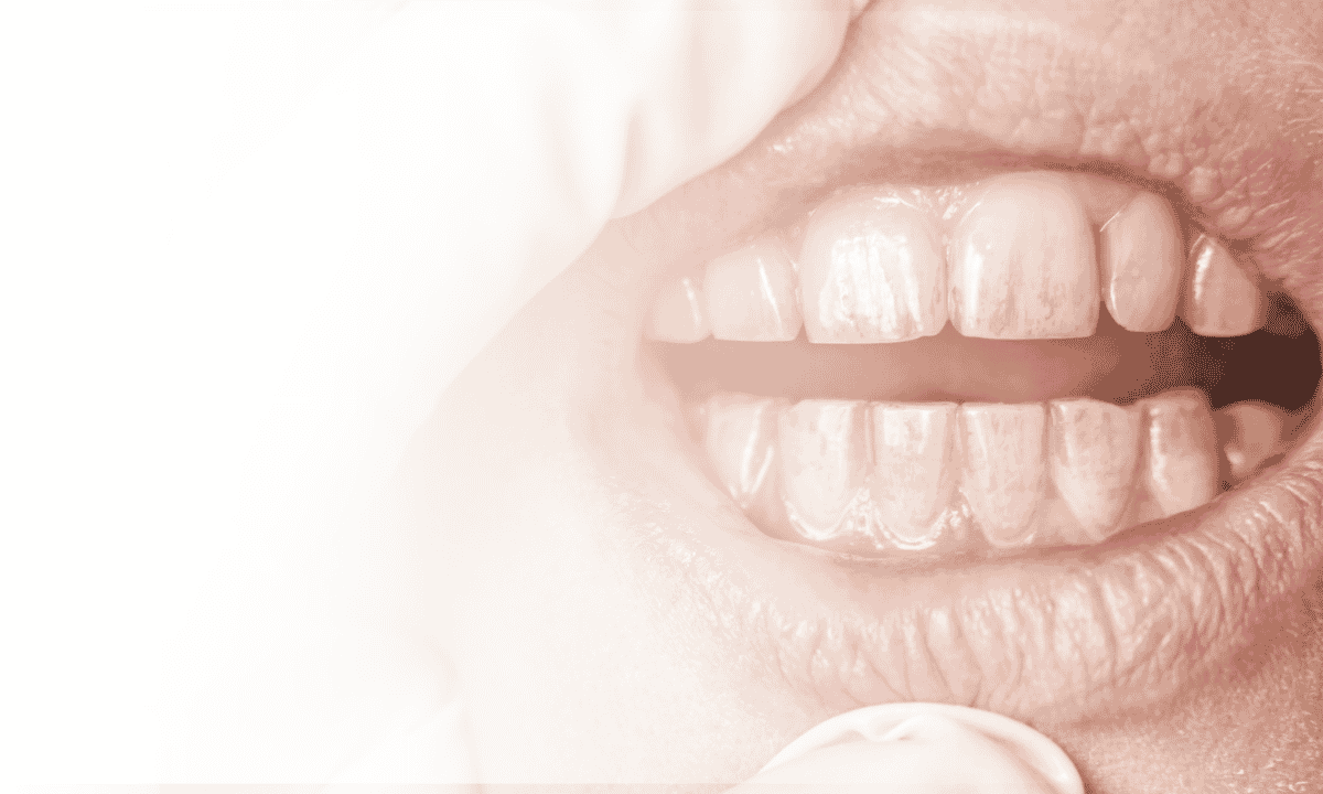 What Are the Different Types of Tooth Wear?