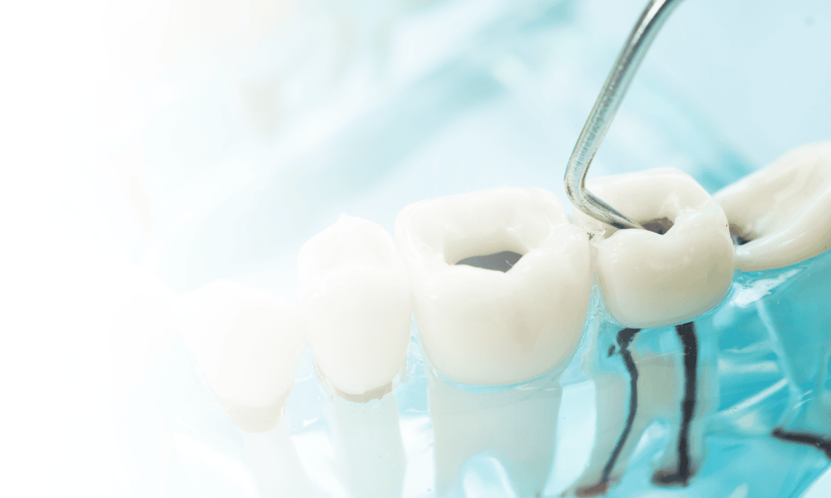 What Causes Dental Decay?