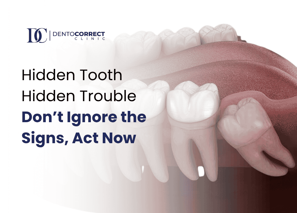 What Is an Impacted Tooth