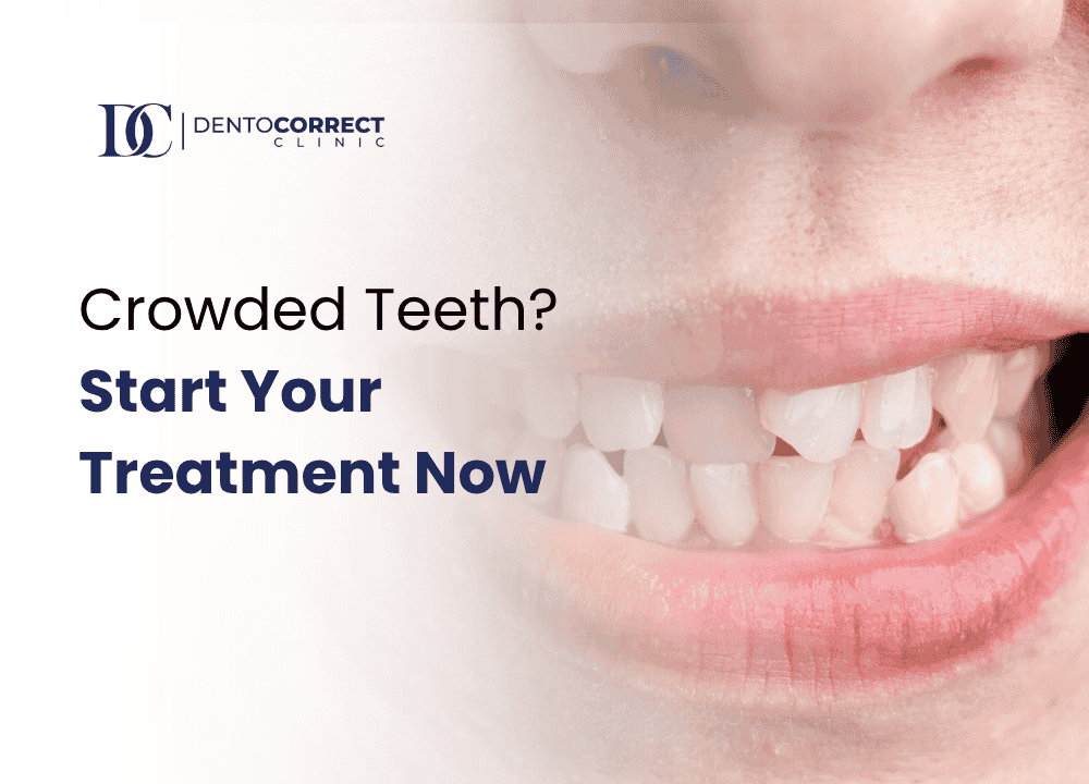 Crowded Teeth? Start Your Treatment Now