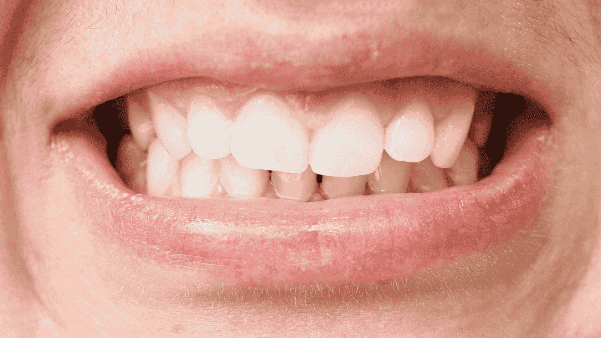Deep bite problem.