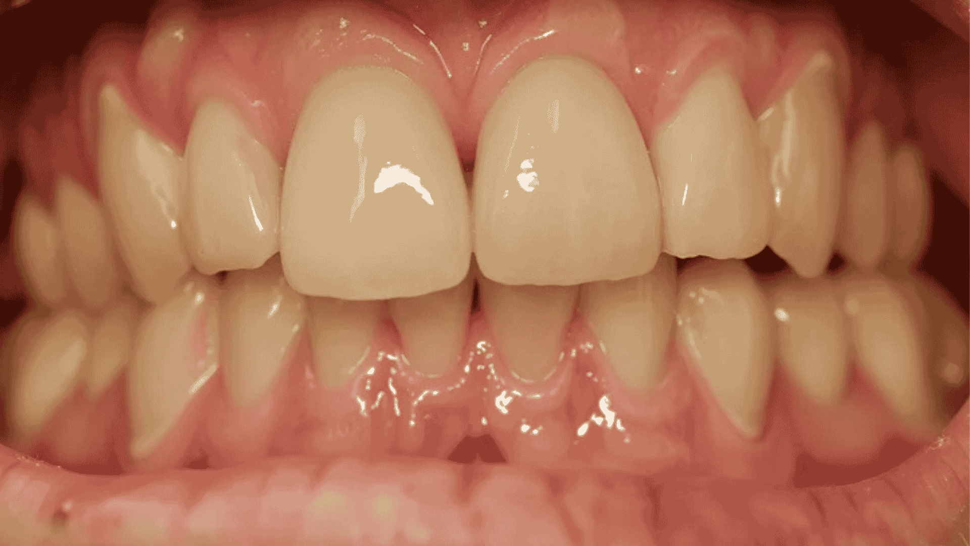 Over bite problem