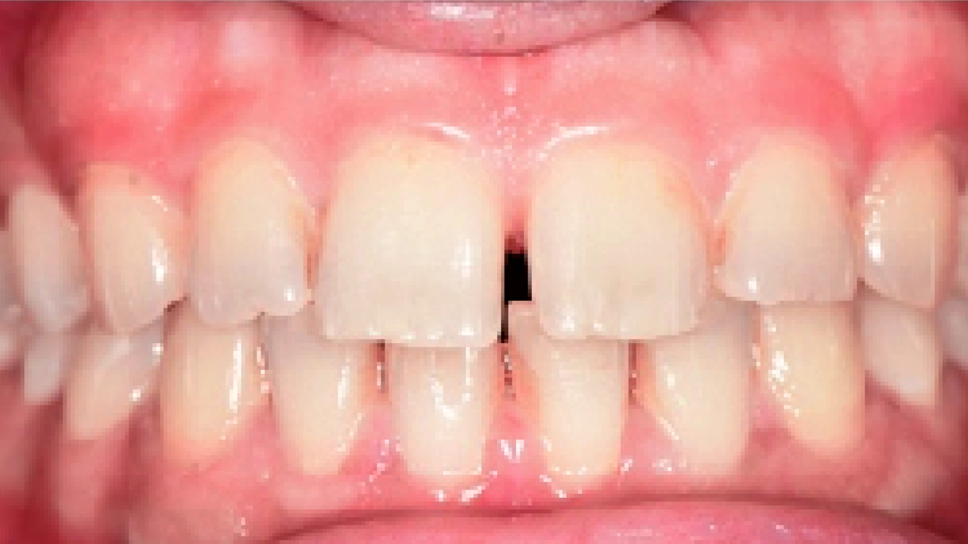 Cross bite problem