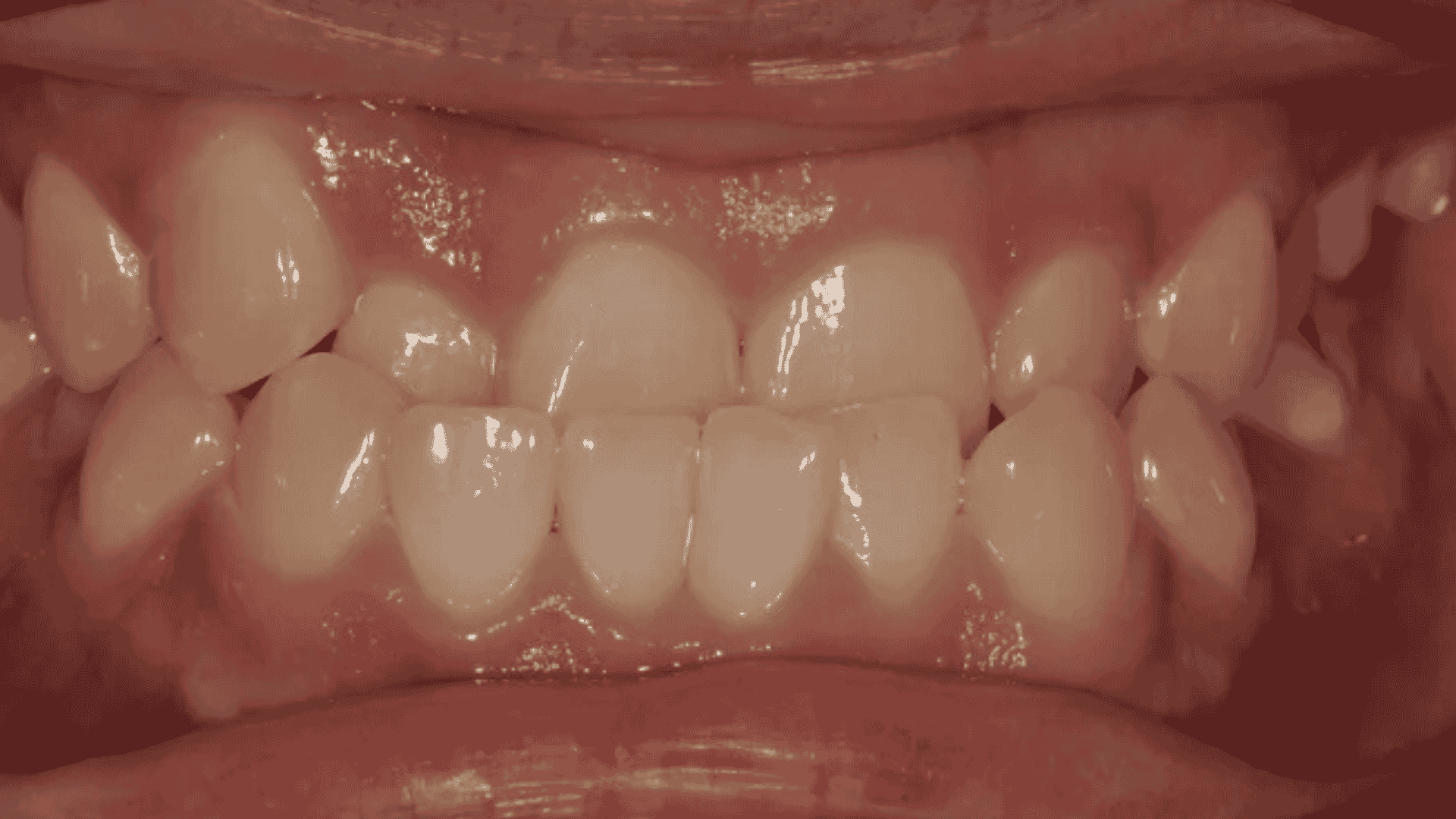 Under bite problem