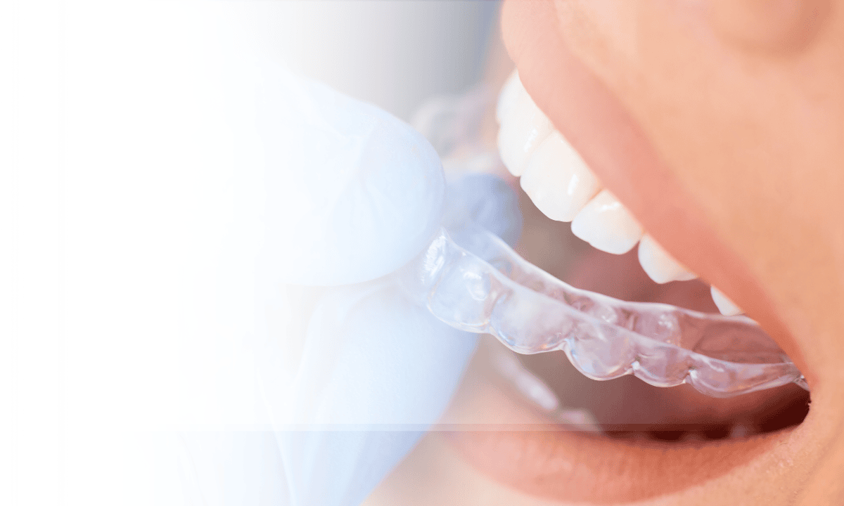 How Clear Aligners Move Teeth