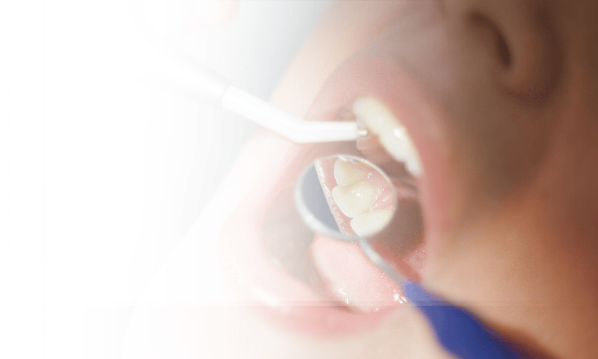 Understanding Tooth Filling: A Complete Guide for Patients