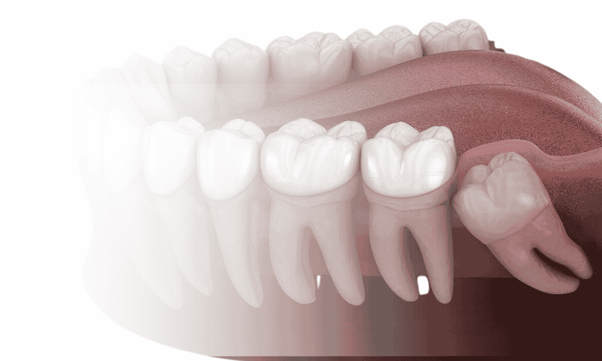 What Is an Impacted Tooth?