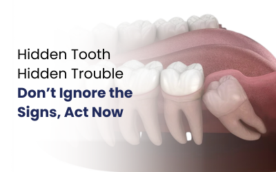 What Is an Impacted Tooth?