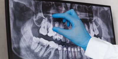 Examination and X-ray of teeth for root canal.