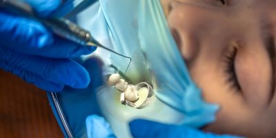 Tooth filling and sealing.
