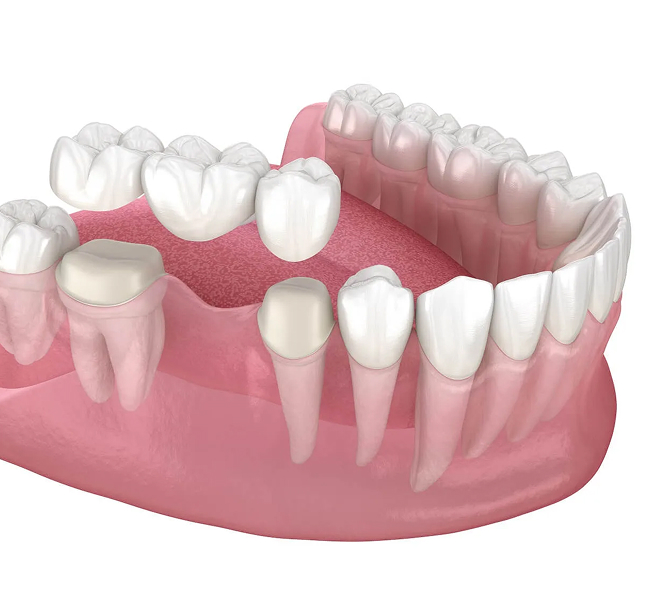 Types of dental bridges at DentoCorrect