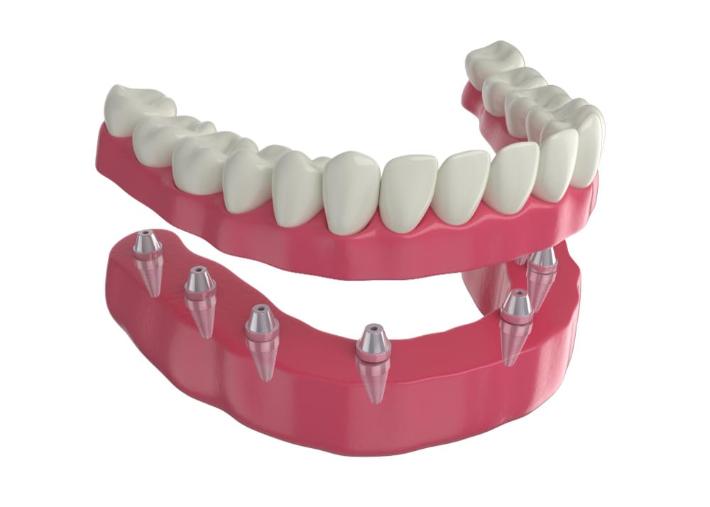 Dental implant model at DentoCorrect