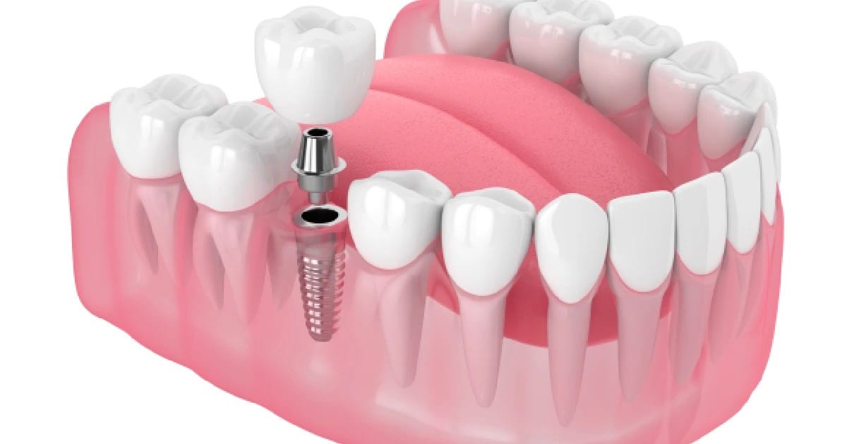 Single Tooth Implant