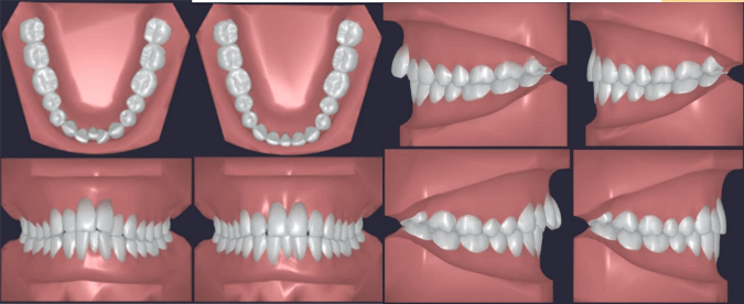 Anticipated Outcome of Clearpath Aligners in Resolving Crowding