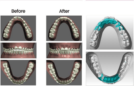 ClearPath: An Invisible Approach for the Correction of Anterior Open Bite