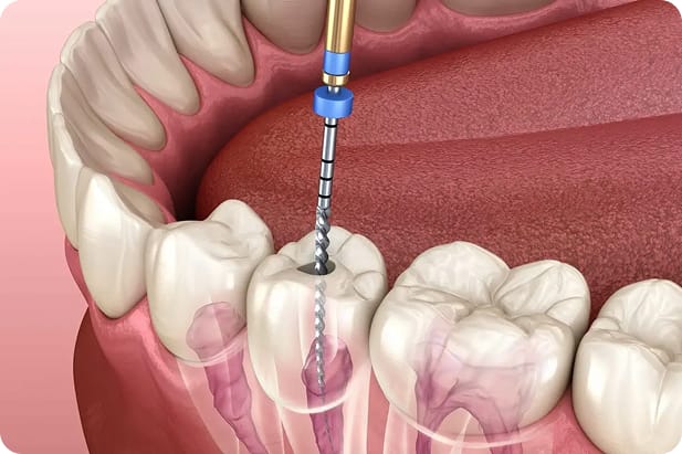 Standard Treatment (Single or Multi-Canal)