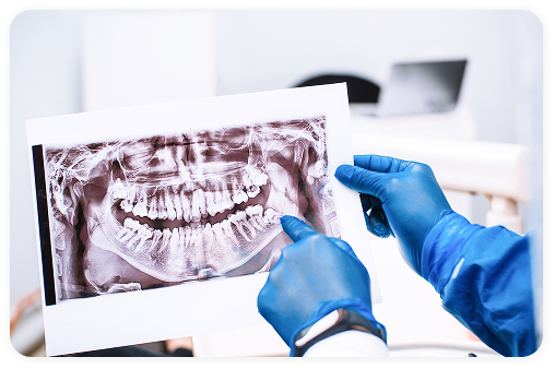 Wisdom Tooth Removal (Third Molar Extraction)