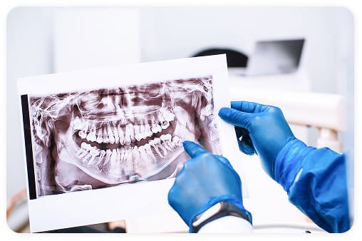Wisdom Tooth Removal (Third Molar Extraction)
