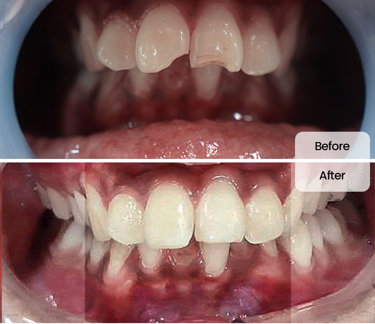 Filling before after