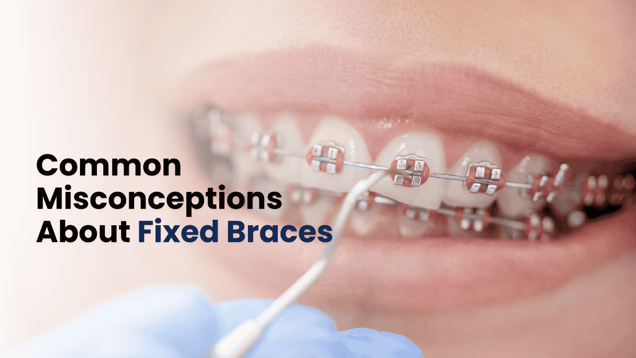 Fixed Braces