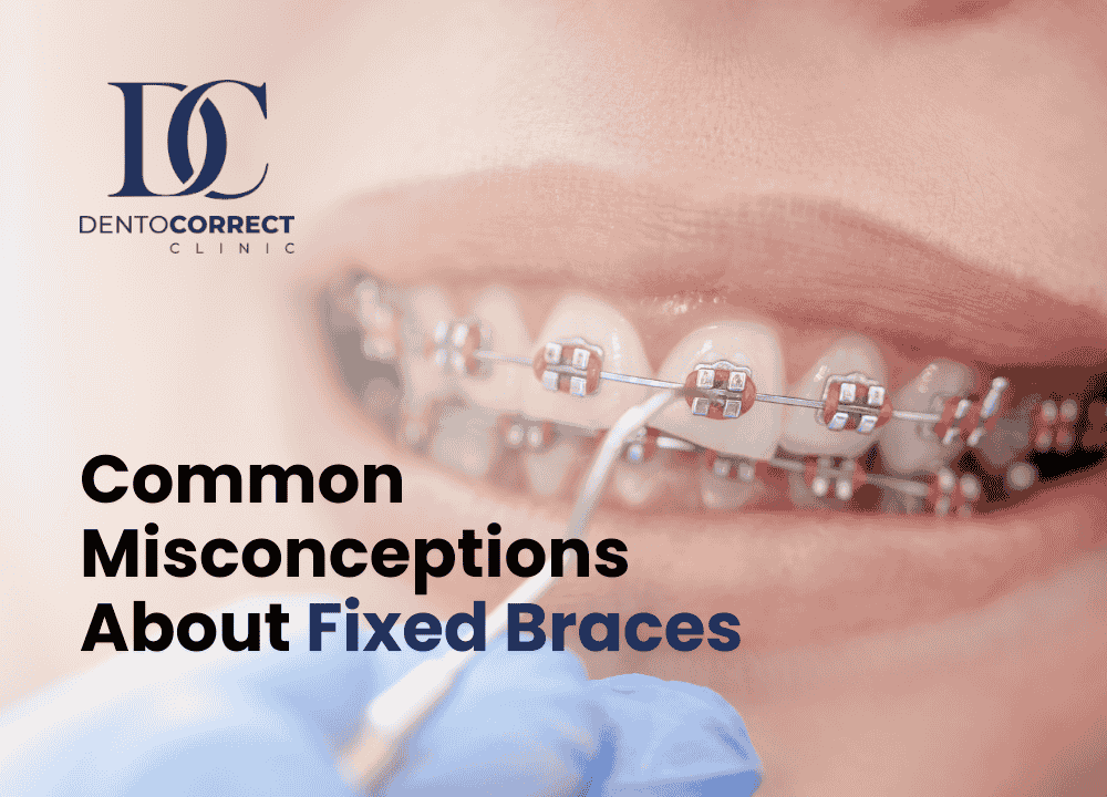 Read more about the article Common Misconceptions About Fixed Braces