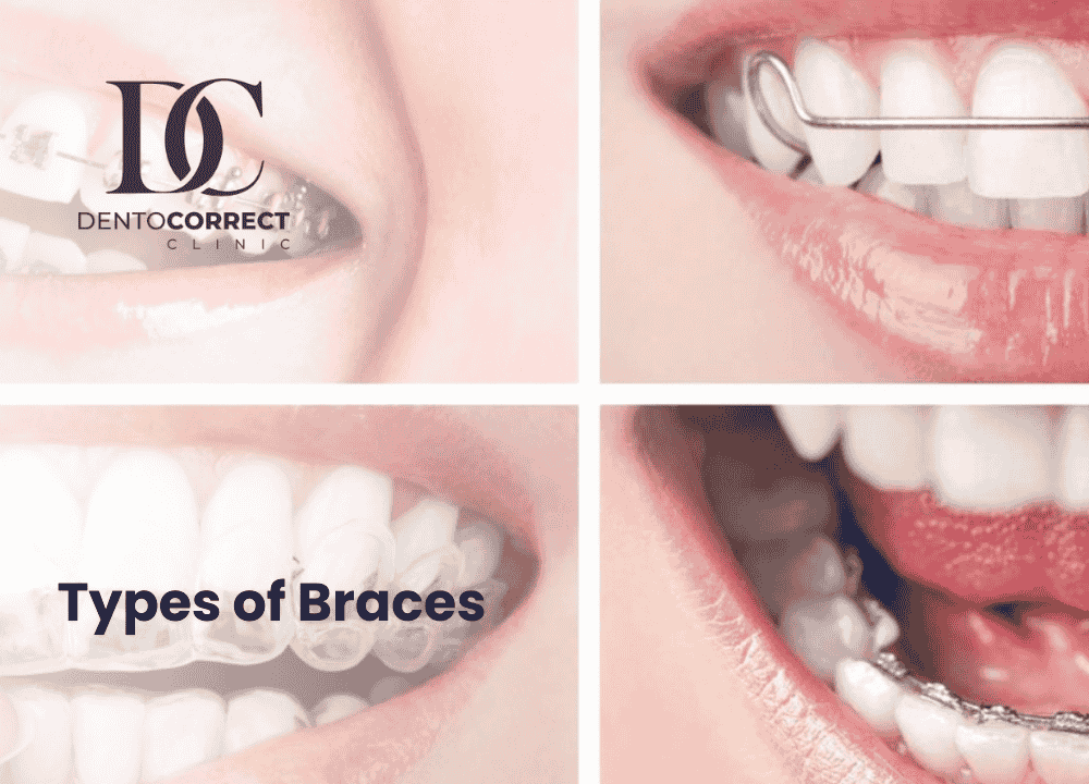 Read more about the article Types of Braces