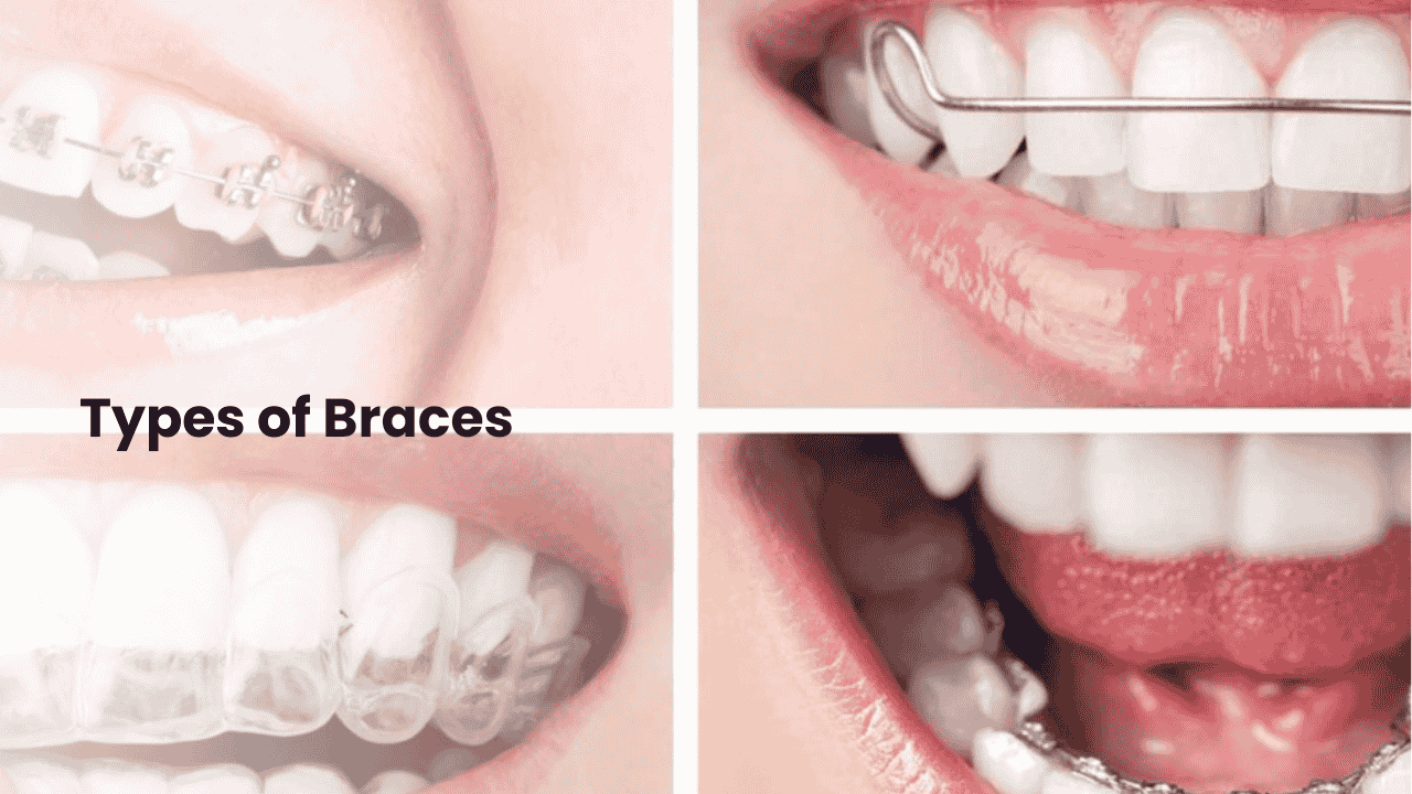 Types of Braces