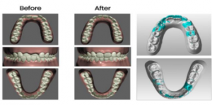 A success stories of smile transformation is described.