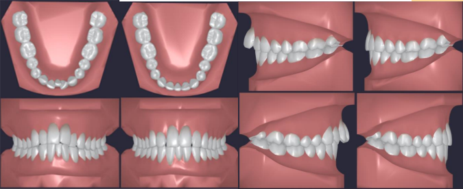 The anticipated outcome of ClearPath Aligners in resolving crowding.